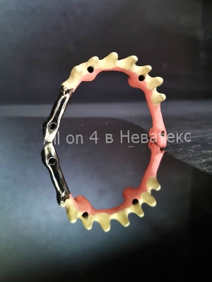 улыбка после имплантации алл он фо балка - основа керамокомпозито-наполненного протеза